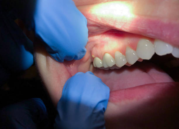 Best Emergency Care for Gum Disease in Lonville, GA